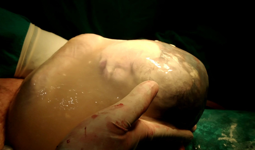 डडेल्धुरामा पानीको थैली सहितको बच्चा जन्मियो