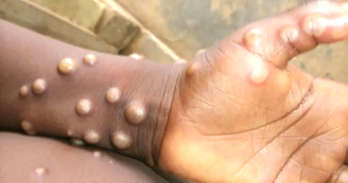 मंकिपक्स भाइरस : डब्लुएचओले भन्यो- नेपाल पनि मंकिपक्सको जोखिममा