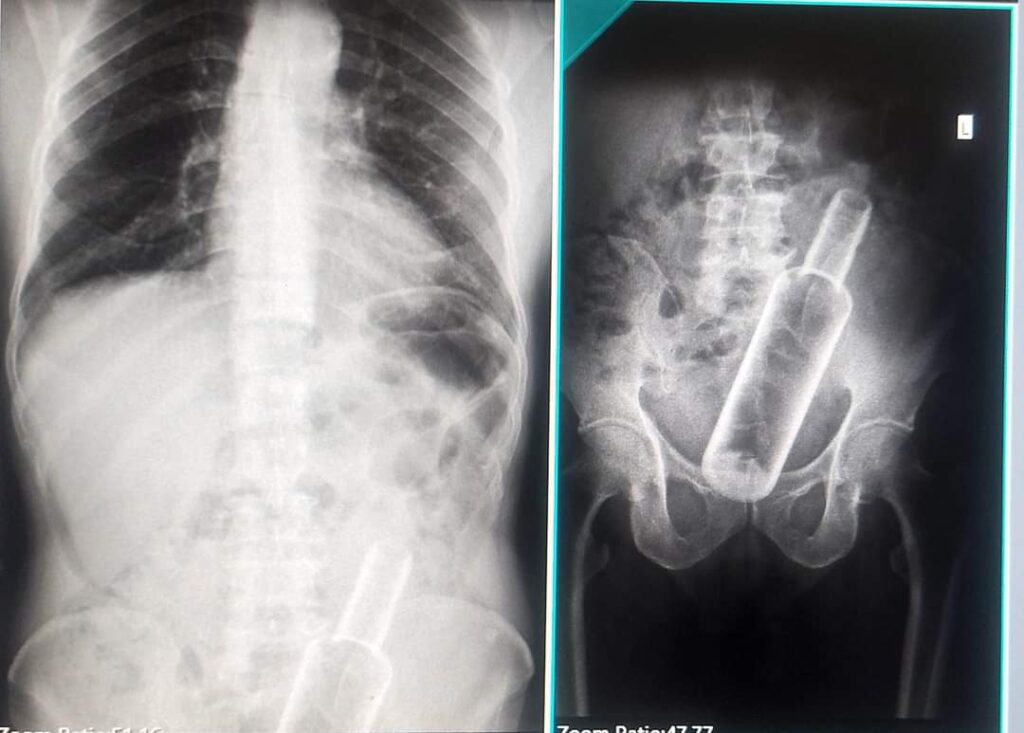 पेटभित्रको रक्सीको बोतल शल्यक्रिया गरेर निकालियो